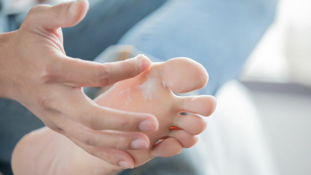 athlete's foot